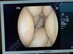FUJIFILM Video Transnasal Gastroscope