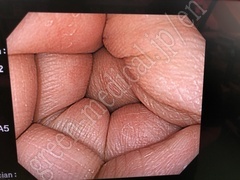 OLYMPUS Video Colonoscope