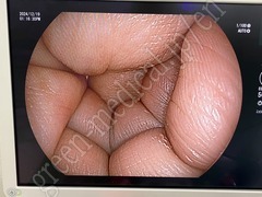 FUJIFILM Video Transnasal Gastroscope