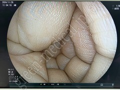 FUJIFILM Video Transnasal Gastroscope