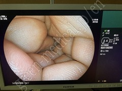 FUJIFILM Video Transnasal Gastroscope