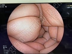 FUJIFILM Double Balloon Endoscope