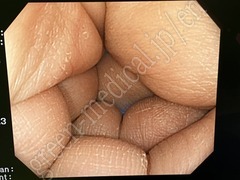 OLYMPUS Video Colonoscope