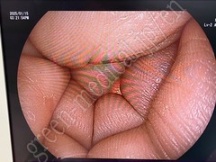 FUJIFILM Video Transnasal Gastroscope