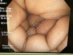 OLYMPUS Video Colonoscope