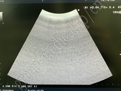 Hitachi Color Doppler Ultrasound System