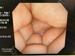 OLYMPUS Video Transnasal Gastroscope