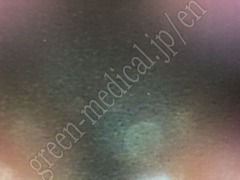 OLYMPUS Video Transnasal Gastroscope