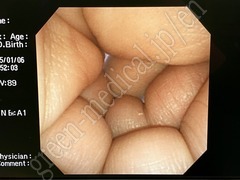 OLYMPUS Video Transnasal Gastroscope