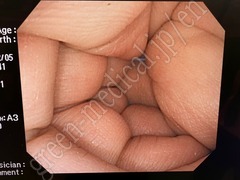 OLYMPUS Video Colonoscope