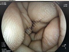 FUJIFILM Transnasal Gastroscope