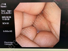 OLYMPUS Video Transnasal Gastroscope