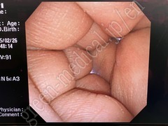 OLYMPUS Video Gastroscope