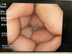 OLYMPUS Video Colonosope