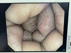 OLYMPUS Video Colonoscope