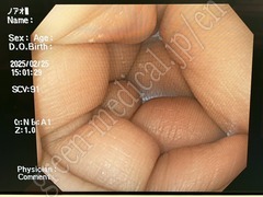 OLYMPUS Video Colonosope