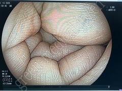 FUJIFILM Video Transnasal Gastroscope