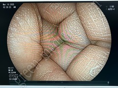 FUJIFILM Video Transnasal Gastroscope