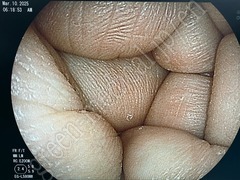 FUJIFILM Video Transnasal Gastroscope