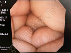 OLYMPUS Video Transnasal Gastroscope