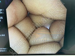 OLYMPUS Video Transnasal Gastroscope