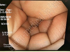 OLYMPUS Video Colonoscope