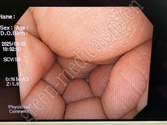 OLYMPUS Video Gastroscope