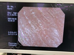 OLYMPUS Video Colonosope