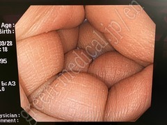 OLYMPUS Video Colonoscope