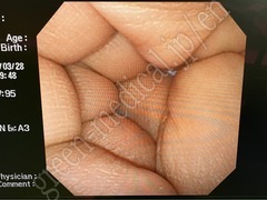 OLYMPUS Video Transnasal Gastroscope