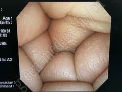 OLYMPUS Video Gastroscope