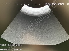 Hitachi Ultrasound Diagnostic System