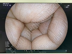 FUJIFILM Video Processor & Laser Lightsource