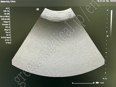 SIEMENS Ultrasound Color Doppler