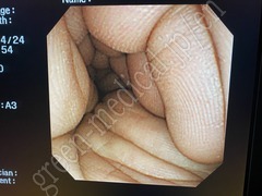 OLYMPUS Video Transnasal Gastroscope