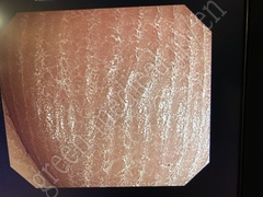 OLYMPUS Video Colonoscope