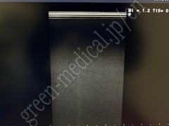 Hitachi Color Doppler Ultrasound System