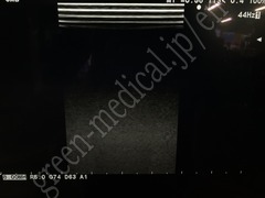 Hitachi Ultrasound Color Doppler