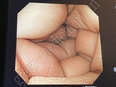 OLYMPUS Video Colonoscope