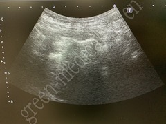 TOSHIBA Ultrasound Color Doppler