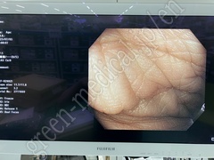 OLYMPUS Video Colonoscope