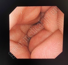 OLYMPUS Video Transnasal Gastroscope