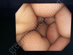 OLYMPUS Video Colonoscope