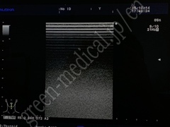 Hitachi Ultrasound Color Doppler