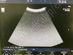 Hitachi Color Doppler Ultrasound System