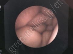 OLYMPUS Video-Fiber Bronchoscope