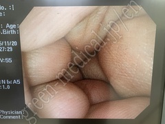 OLYMPUS Video Colonoscope