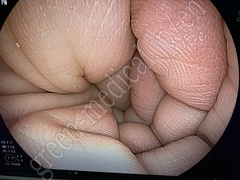 FUJIFILM Video Transnasal Gastroscope