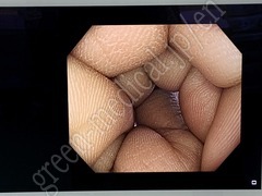 OLYMPUS Video Colonoscope