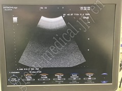 Hitachi Color Doppler Ultrasound System